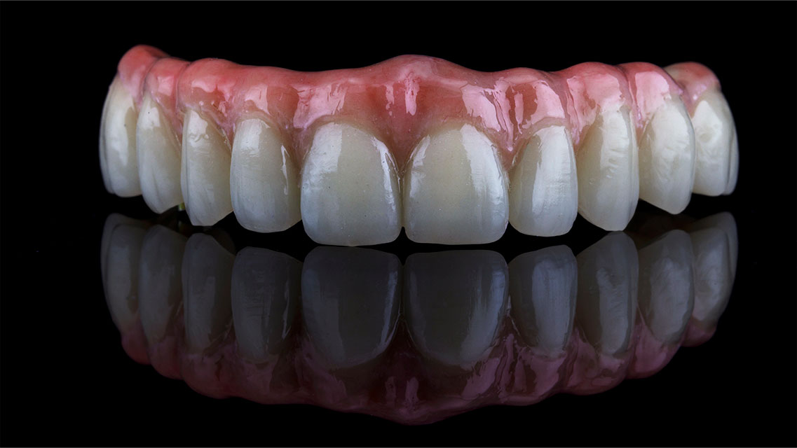 All-on-4 i All-on-6 implantati