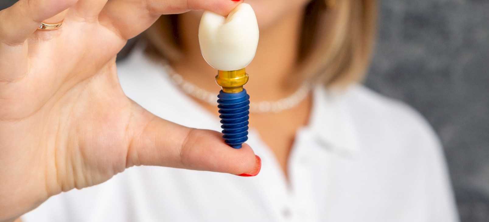 Koliko dugo traju zubni implantati i što utječe na njihovu dugovječnost?