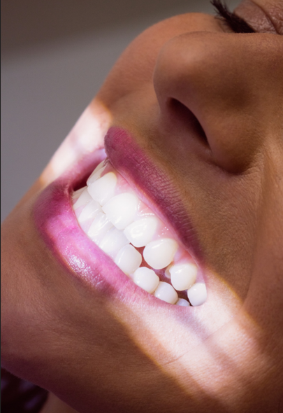 Prava razlika: ljuskice vs. izbjeljivanje zubi