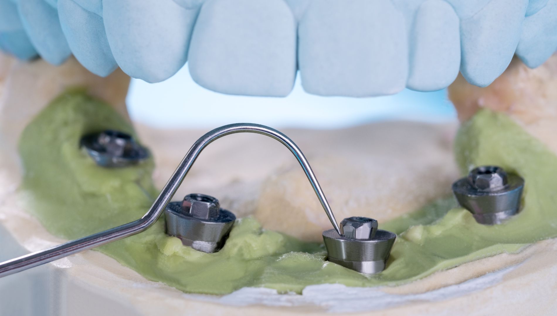 Je li vrijeme za prelazak s proteze na implantate?