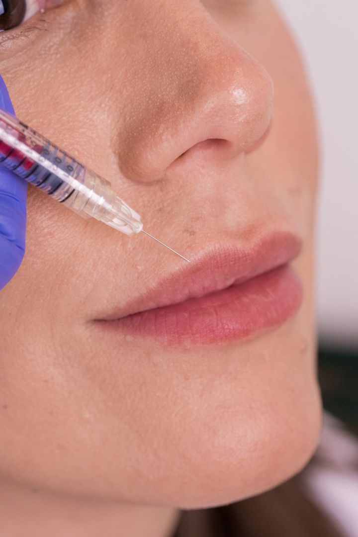 Mogu li hijaluronski fileri izgledati prirodno?